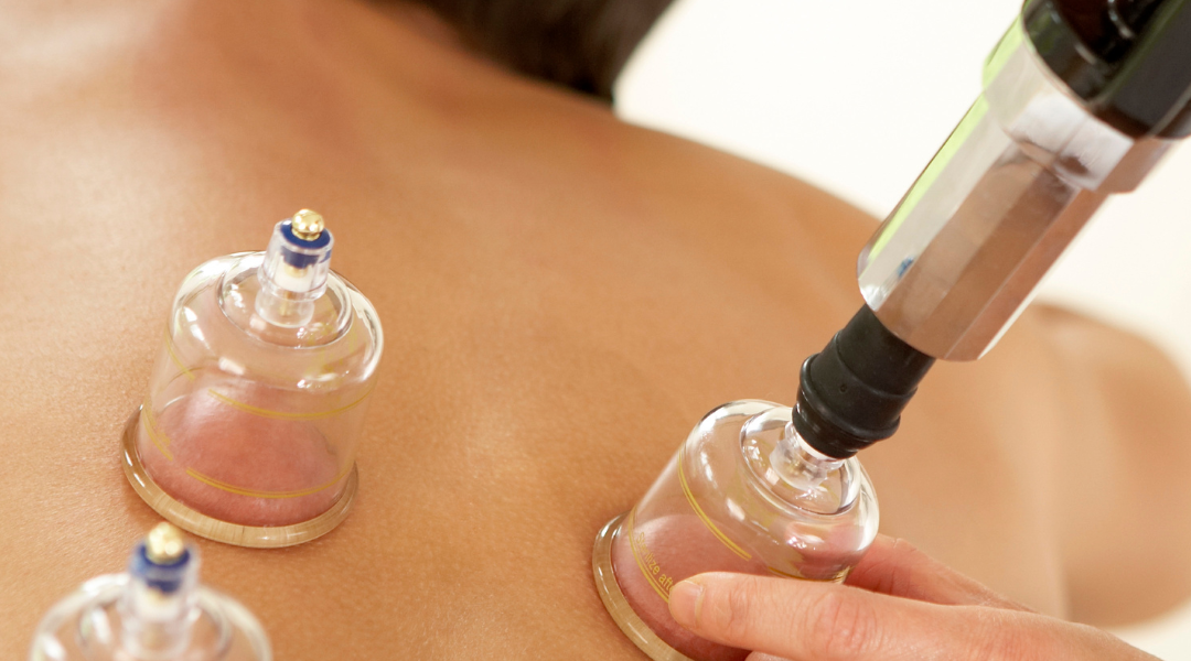 Cupping Therapy: Ancient Healing for Modern Wellness - Texas MedClinic Careers