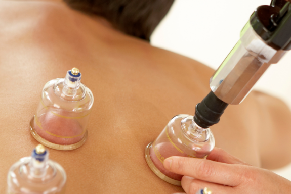 Cupping Therapy: Ancient Healing for Modern Wellness - Essence Acupuncture Wellness - East Asian Medicine Healthcare