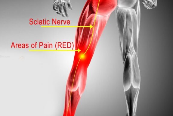 Acupuncture and Sciatica: A Natural Approach to Lasting Pain Relief - Essence Acupuncture Wellness - East Asian Medicine Healthcare