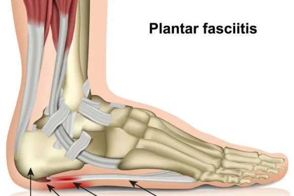 Plantar Fasciitis: Relief You Can Feel - Essence Acupuncture Wellness - East Asian Medicine Healthcare