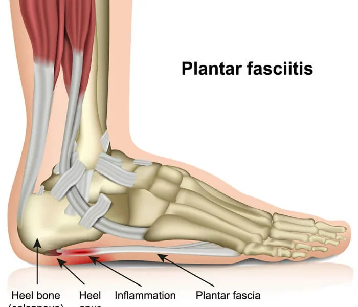 Plantar Fasciitis: Relief You Can Feel - Texas MedClinic Careers